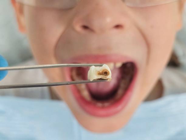 Best Emergency Treatment for Dental Infections or Abscesses in Hastings, PA